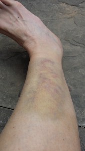 climbing leg bruise
